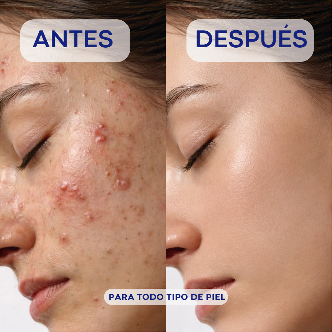 Crema anti acné grado dermatológico - Three Herb